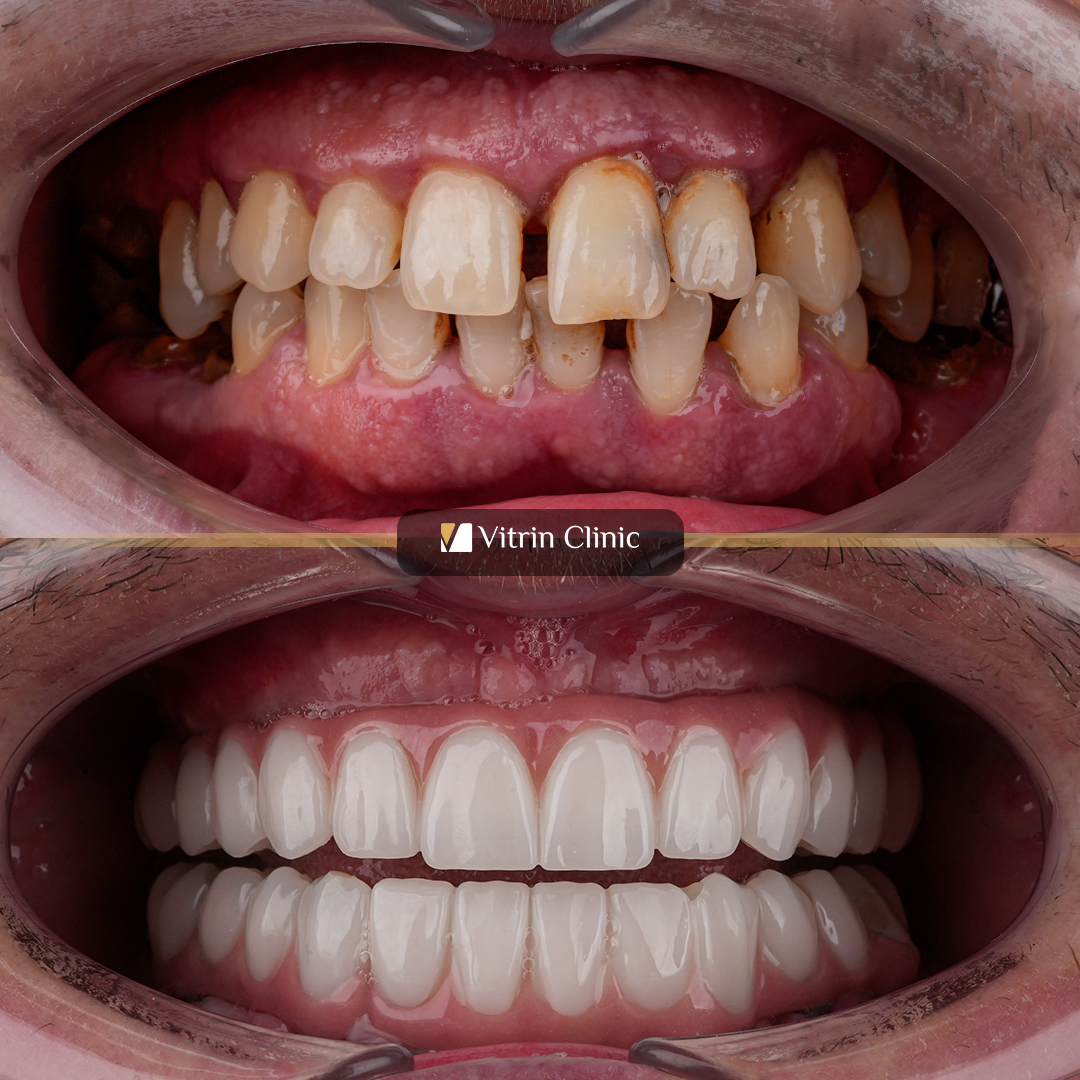 Dmitry dental implants